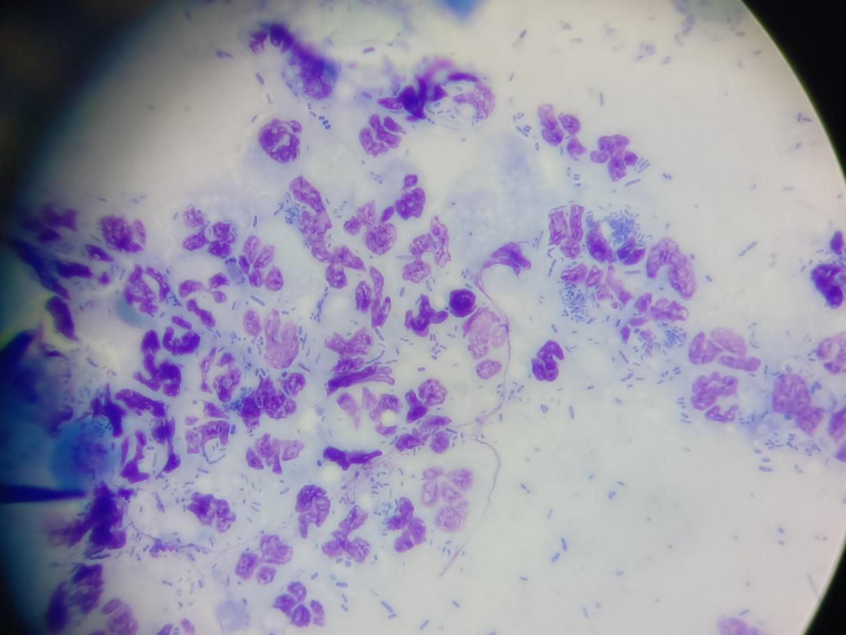 Otitis externa unter dem Mikroskop_Entzündungszellen und massenhaft stäbchenförmige Bakterien